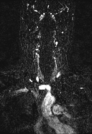Carotid artery dissection (Radiopaedia 28441-28689 Coronal MRA 25).jpg