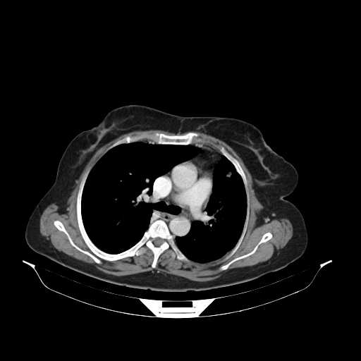File:Carotid body tumor (Radiopaedia 21021-20948 B 36).jpg