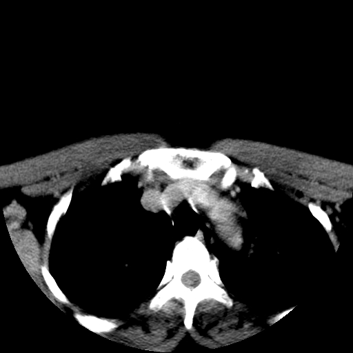 File:Carotid body tumor (Radiopaedia 27890-28124 A 35).jpg