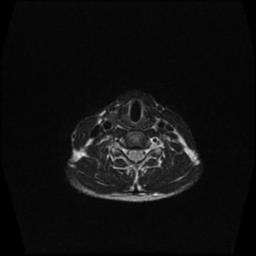 File:Carotid body tumor (Radiopaedia 30208-30823 Axial T2 3).jpg