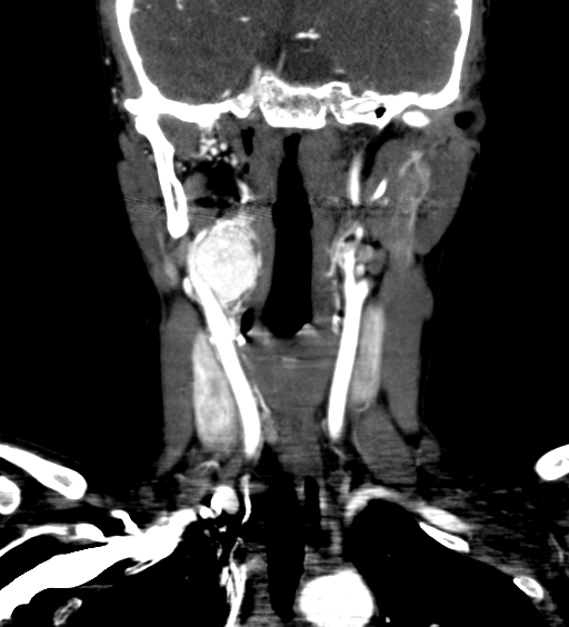 Carotid body tumor (Radiopaedia 39845-42300 C 30).jpg