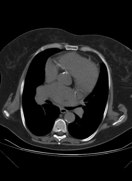 File:Caseous mitral annular calcification (Radiopaedia 61219-69122 Axial non-contrast 3).jpg