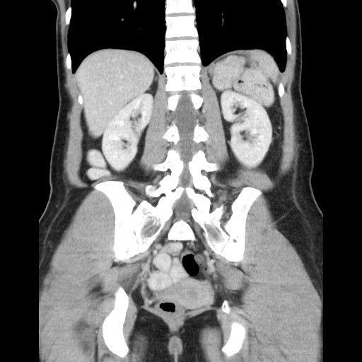 Castleman disease with fibrous pseudotumor in the abdomen (Radiopaedia 77296-89373 B 67).jpg