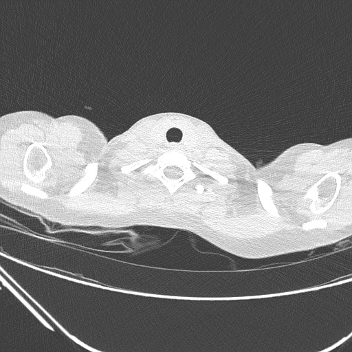 Catamenial pneumothorax (Radiopaedia 27946-28197 lung window 12).jpg