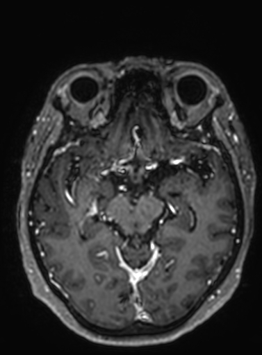 Cavernous hemangioma of the cerebellar falx (Radiopaedia 73025-83724 Axial T1 C+ 198).jpg