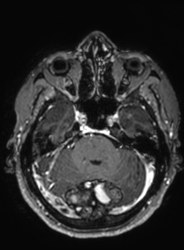 Cavernous hemangioma of the cerebellar falx (Radiopaedia 73025-83724 Axial T1 C+ 240).jpg