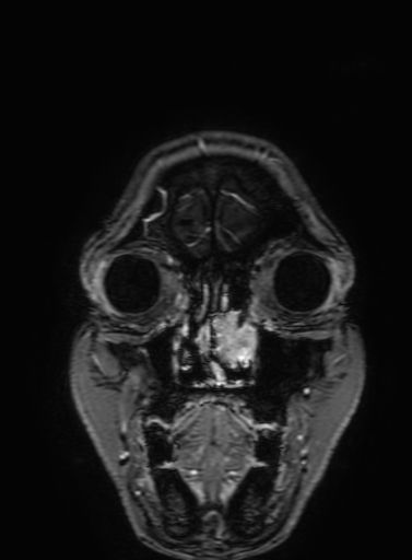 Cavernous hemangioma of the cerebellar falx (Radiopaedia 73025-83724 Coronal T1 C+ 32).jpg