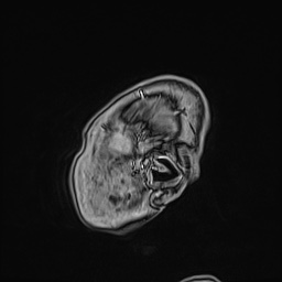 File:Cavernous sinus meningioma (Radiopaedia 63682-72367 Sagittal T1 C+ 20).jpg