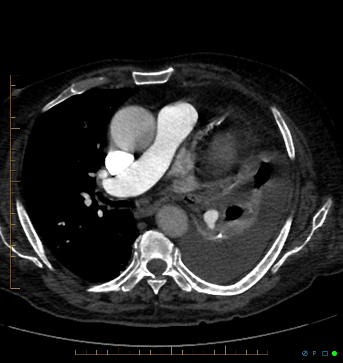 Cavitating pulmonary infarction (Radiopaedia 54634-60849 Axial C+ CTPA 37).jpg