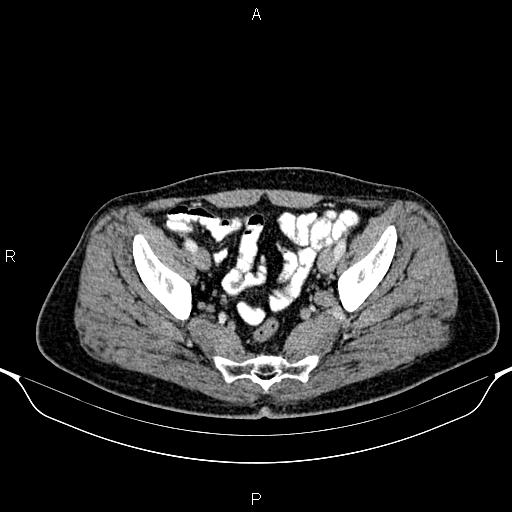 Cecal adenocarcinoma (Radiopaedia 85324-100916 B 84).jpg