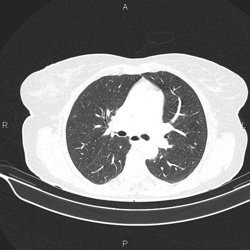 Cecal cancer (Radiopaedia 85610-101358 Axial lung window 29).jpg