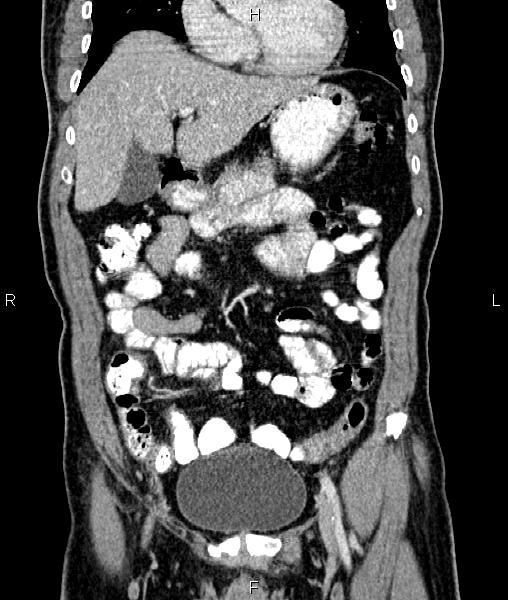 File:Cecal cancer with appendiceal mucocele (Radiopaedia 91080-108651 D 24).jpg