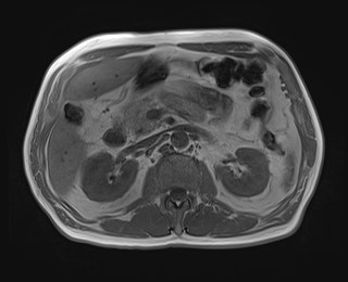 File:Cecal mass causing appendicitis (Radiopaedia 59207-66532 Axial T1 in-phase 53).jpg