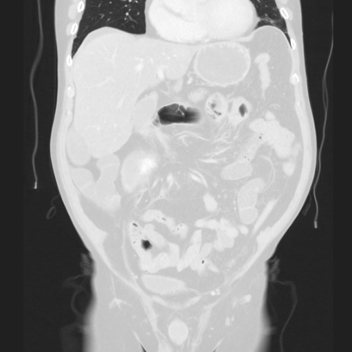 Cecal volvulus (Radiopaedia 75378-86620 Coronal lung window 61).jpg