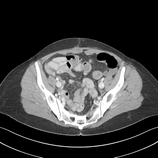 Cecum hernia through the foramen of Winslow (Radiopaedia 46634-51112 A 57).png