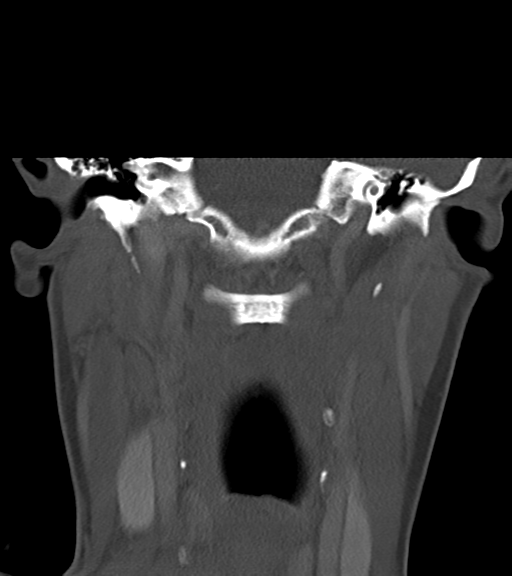 Cemento-ossifying fibroma (Radiopaedia 46243-50643 Coronal bone window 40).png