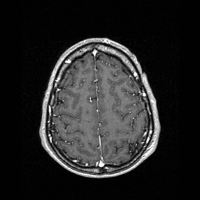 File:Central-variant posterior reversible encephalopathy syndrome (PRES) (Radiopaedia 43880-47358 Axial T1 C+ 137).jpg