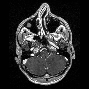 Central-variant posterior reversible encephalopathy syndrome (PRES) (Radiopaedia 43880-47358 Axial T1 C+ 23).jpg