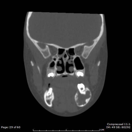 Central giant cell granuloma (Radiopaedia 45612-49754 Coronal bone window 29).jpg