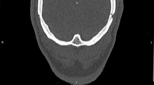 Central giant cell granuloma (Radiopaedia 83346-97761 Coronal bone window 53).jpg