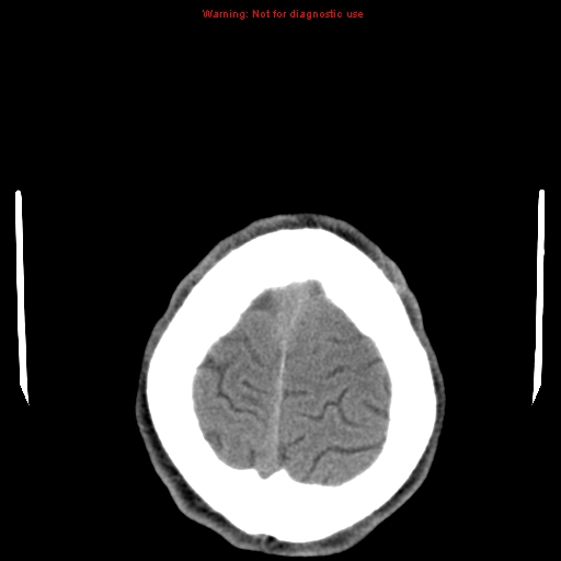 File:Central nervous system vasculitis (Radiopaedia 8410-9234 Axial non-contrast 25).jpg