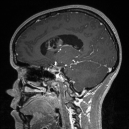 Central neurocytoma (Radiopaedia 37664-39557 Sagittal T1 C+ 57).png