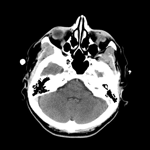 Central neurocytoma (Radiopaedia 68725-78432 Axial C+ 11).jpg