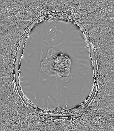 File:Central neurocytoma (Radiopaedia 84497-99872 Axial 45).jpg