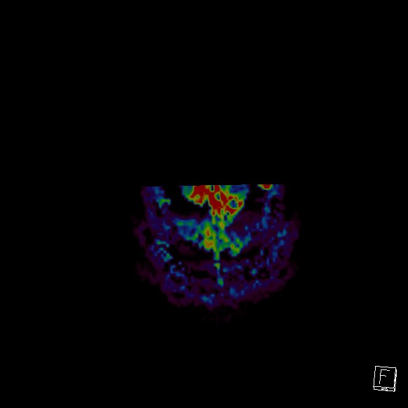 Central neurocytoma (Radiopaedia 84497-99872 Axial Perfusion 5).jpg