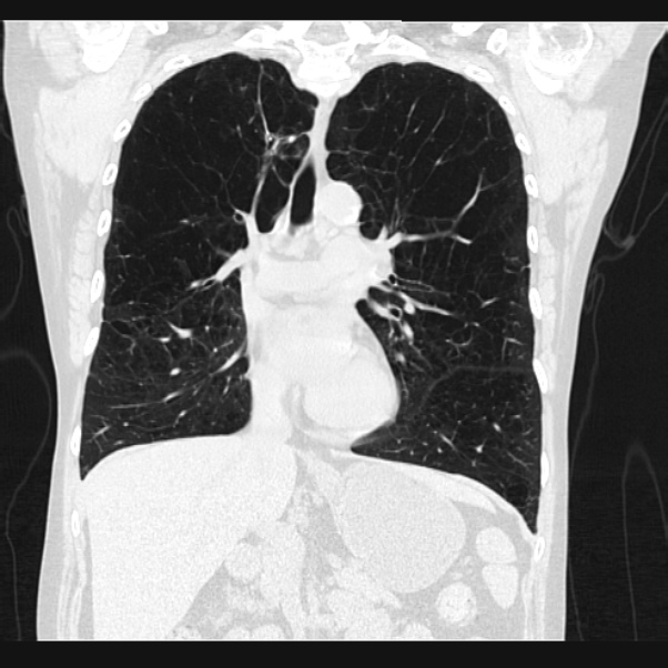 Centrilobular pulmonary emphysema (Radiopaedia 24495-24789 Coronal lung window 35).jpg