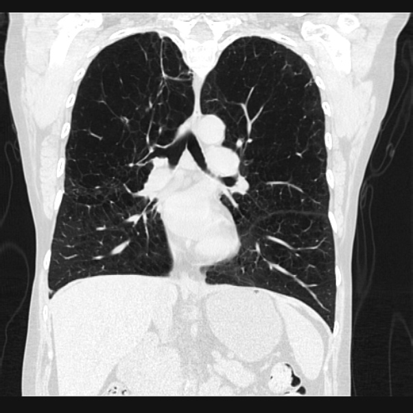 Centrilobular pulmonary emphysema (Radiopaedia 24495-24789 Coronal lung window 39).jpg