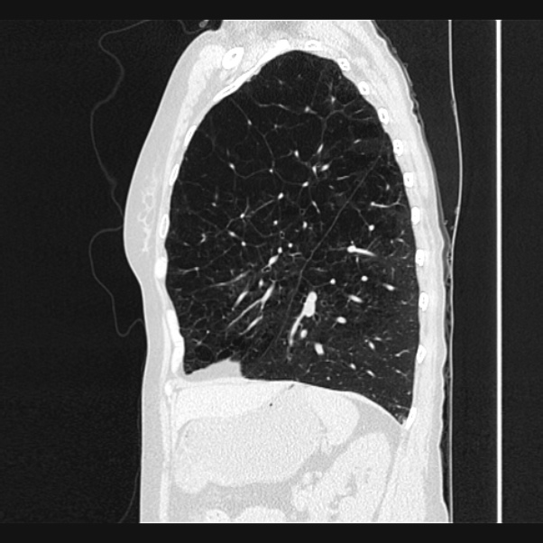 Centrilobular pulmonary emphysema (Radiopaedia 24495-24789 Sagittal lung window 61).jpg
