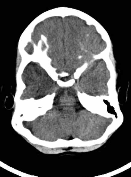 Cerebellar abscess (Radiopaedia 73727-84527 Axial non-contrast 27).jpg