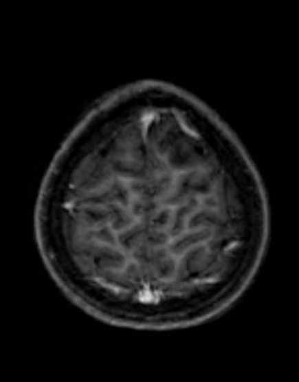Cerebellar abscess (Radiopaedia 73727-84563 Axial T1 C+ fat sat 94).jpg
