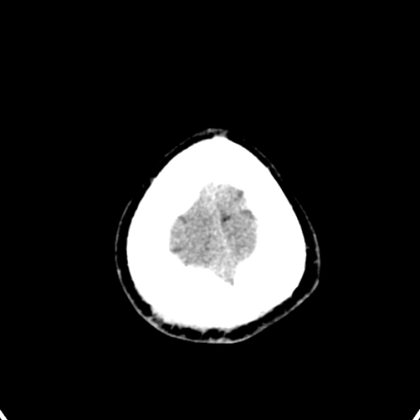 Cerebellar abscess secondary to mastoiditis (Radiopaedia 26284-26412 Axial non-contrast 148).jpg
