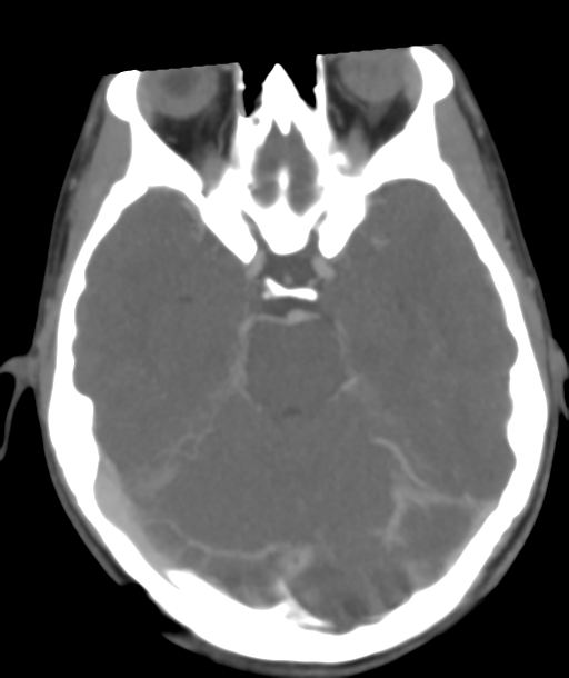 Cerebellar arteriovenous malformation- with hemorrhage (Radiopaedia 35752-37297 B 19).png