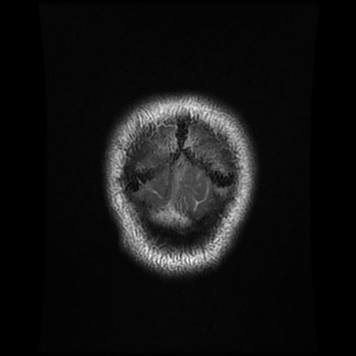 File:Cerebellar hemangioblastoma (Radiopaedia 88055-104622 Coronal T2 20).jpg