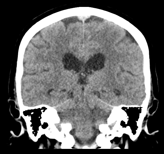 Cerebellar metastasis (Radiopaedia 54578-60812 Coronal non-contrast 34).png