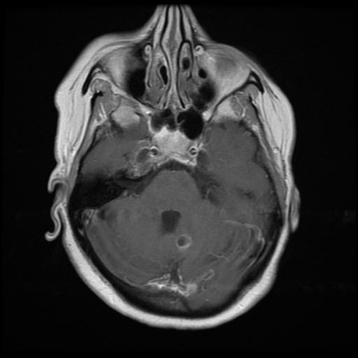 File:Cerebellar metastasis (cystic appearance) (Radiopaedia 41395-44268 Axial T1 C+ 7).png
