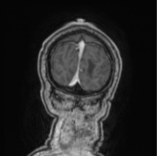Cerebellar metastasis from lung adenocarcinoma (Radiopaedia 86690-102829 Coronal T1 C+ 9).png