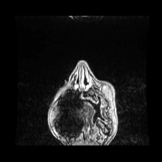 Cerebellar metastasis of pulmonary adenocarcinoma, cavernous venous malformation, and developmental venous anomaly (Radiopaedia 85827-101661 Coronal T1 C+ 101).jpg