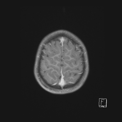 Cerebellar stroke (Radiopaedia 32202-33150 Axial T1 C+ 60).png