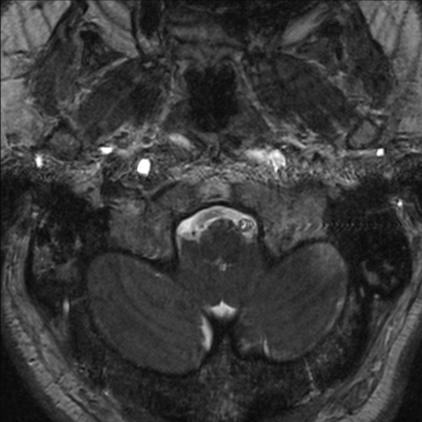Cerebellopontine angle meningioma (Radiopaedia 24459-24764 I 3).jpg