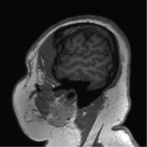 File:Cerebellopontine angle meningioma (Radiopaedia 48434-53348 Sagittal T1 16).png