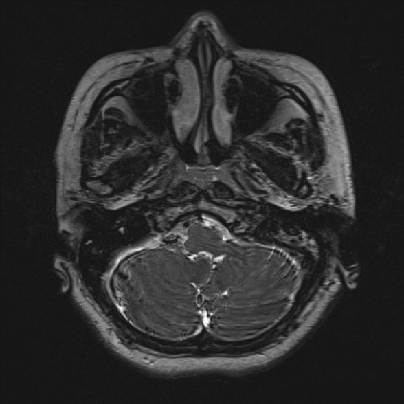 Cerebellopontine angle meningioma (Radiopaedia 53561-59591 Axial 3D volume T2 32).jpg