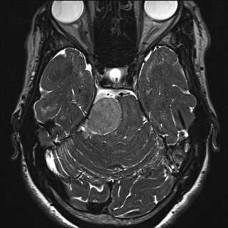 Cerebellopontine angle meningioma (Radiopaedia 72983-83680 Axial FIESTA 48).jpg