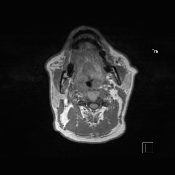 Cerebral abscess (Radiopaedia 26111-26247 Axial T1 2).jpg