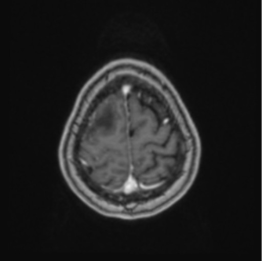Cerebral abscess from pulmonary arteriovenous malformation (Radiopaedia 86275-102291 Axial T1 C+ 66).png