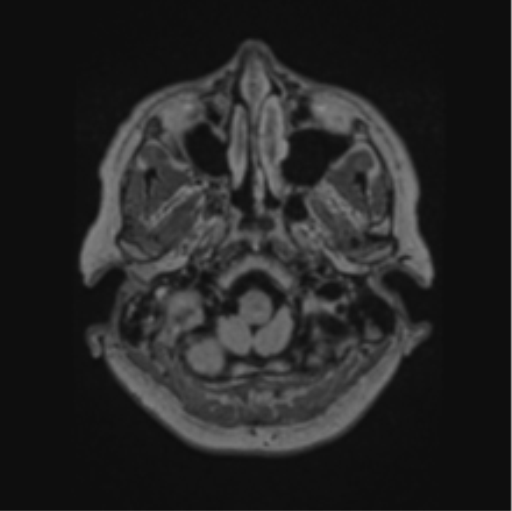Cerebral abscess from pulmonary arteriovenous malformation (Radiopaedia 86275-102291 J 13).png