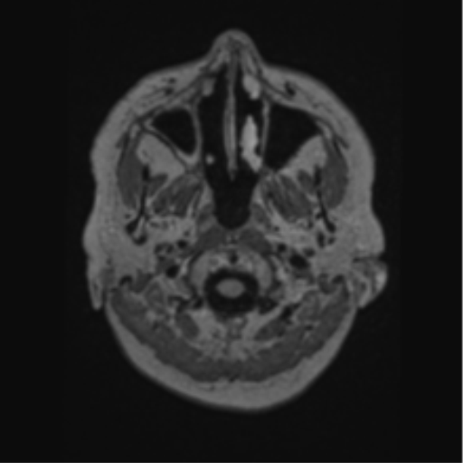 File:Cerebral abscess from pulmonary arteriovenous malformation (Radiopaedia 86275-102291 J 6).png